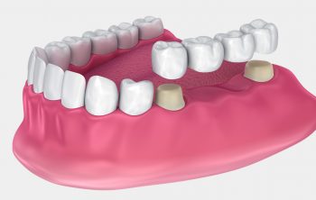 Restorative Dentistry: The Benefits Of Dental Bridge