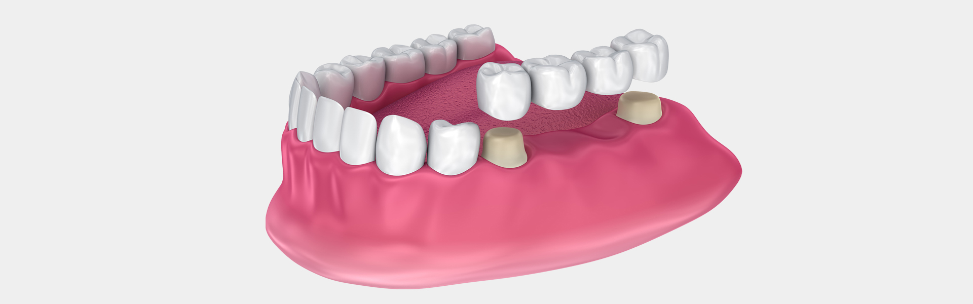 Restorative Dentistry: The Benefits Of Dental Bridge