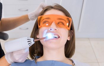 How Long Does Dental Bonding Last On Front Teeth?