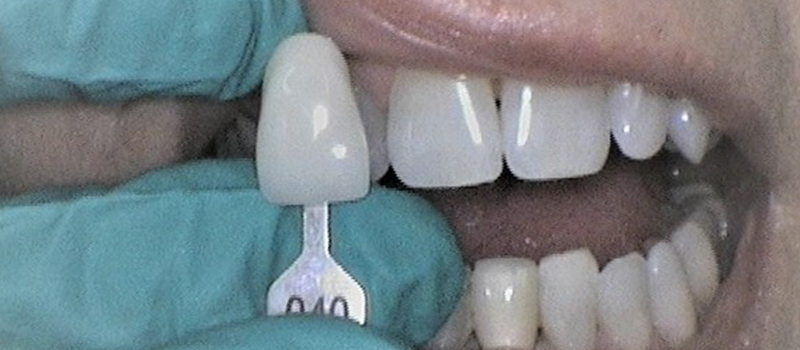 Opalescent teeth whitening - After
