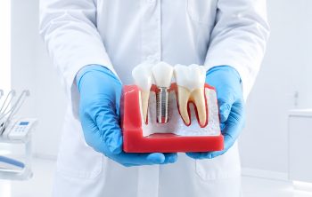 Why Dental Implants Are the Best Solution for Missing Teeth