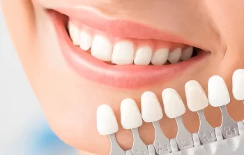 The Ultimate Guide to Choosing Dental Veneers: Porcelain vs. Composite