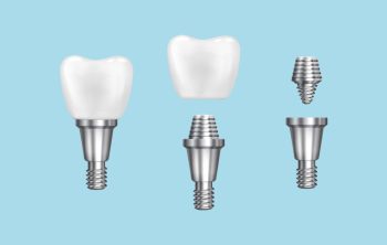 Save $500 on Dental Implants at Rock River Dental in Fort Atkinson