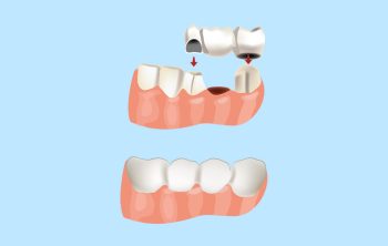 Does Insurance Cover Dental Bridges? What Wisconsin Patients Should Know